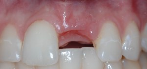 dental implant case study