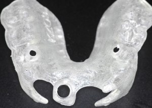 dental implant case study