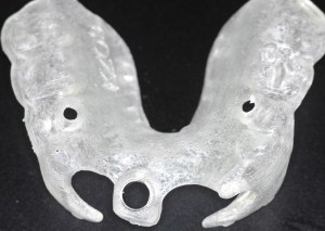 dental implant case study