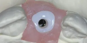 dental implant case study