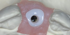 dental implant case study