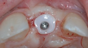 dental implant case study