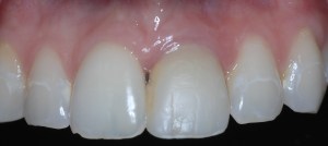 After dental implants