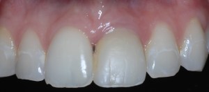 After dental implants