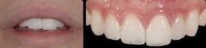 dental implant case study