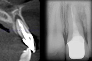 Dental implant xray