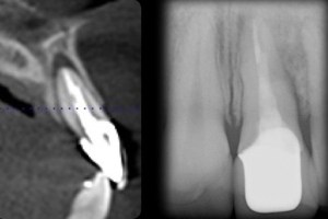 Dental implant xray