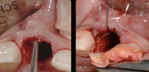 dental implant case study