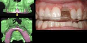 dental implant case study
