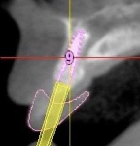Dental implant xray