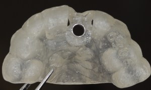 dental implant case study