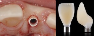 dental implant case study