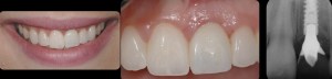 dental implant case study