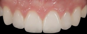After dental implants