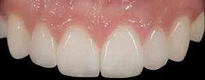 After dental implants