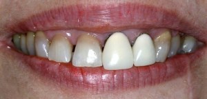 dental implant case study