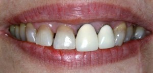 dental implant case study