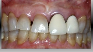 dental implant case study