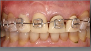 dental implant case study