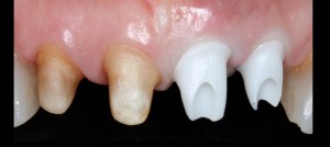 dental implant case study