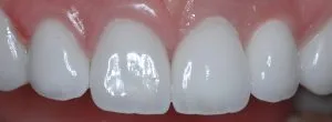 After dental implants