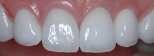 After dental implants