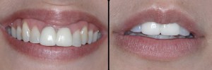 dental implant case study