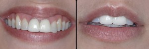 dental implant case study