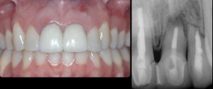 dental implant case study