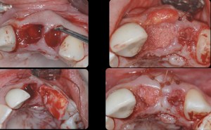 dental implant case study