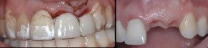 dental implant case study
