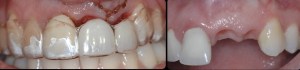 dental implant case study