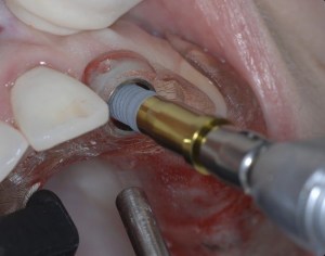 dental implant case study