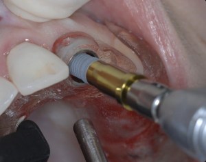 dental implant case study
