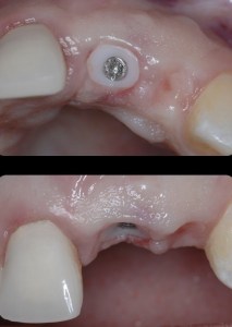 dental implant case study