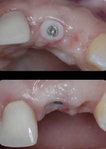 dental implant case study