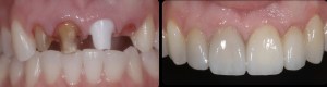 dental implant case study