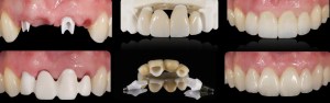 dental implant case study
