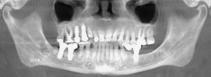 Xray of a mouth with dental implants