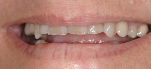 dental implant case study