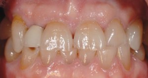 dental implant case study