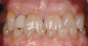 dental implant case study
