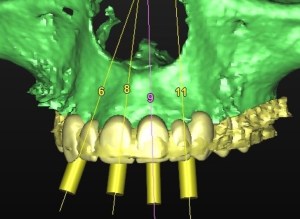 dental implant case study