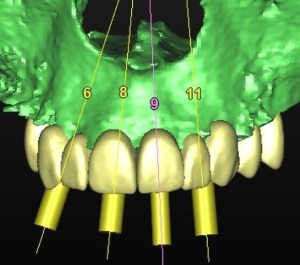 dental implant case study