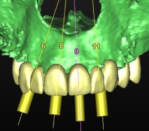 dental implant case study