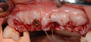 dental implant case study