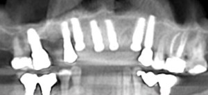 xray of a mouth with dental implants