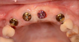 dental implant case study