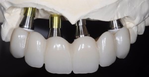 dental implant case study