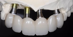 dental implant case study